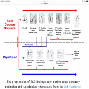 Occlusion Reperfusion